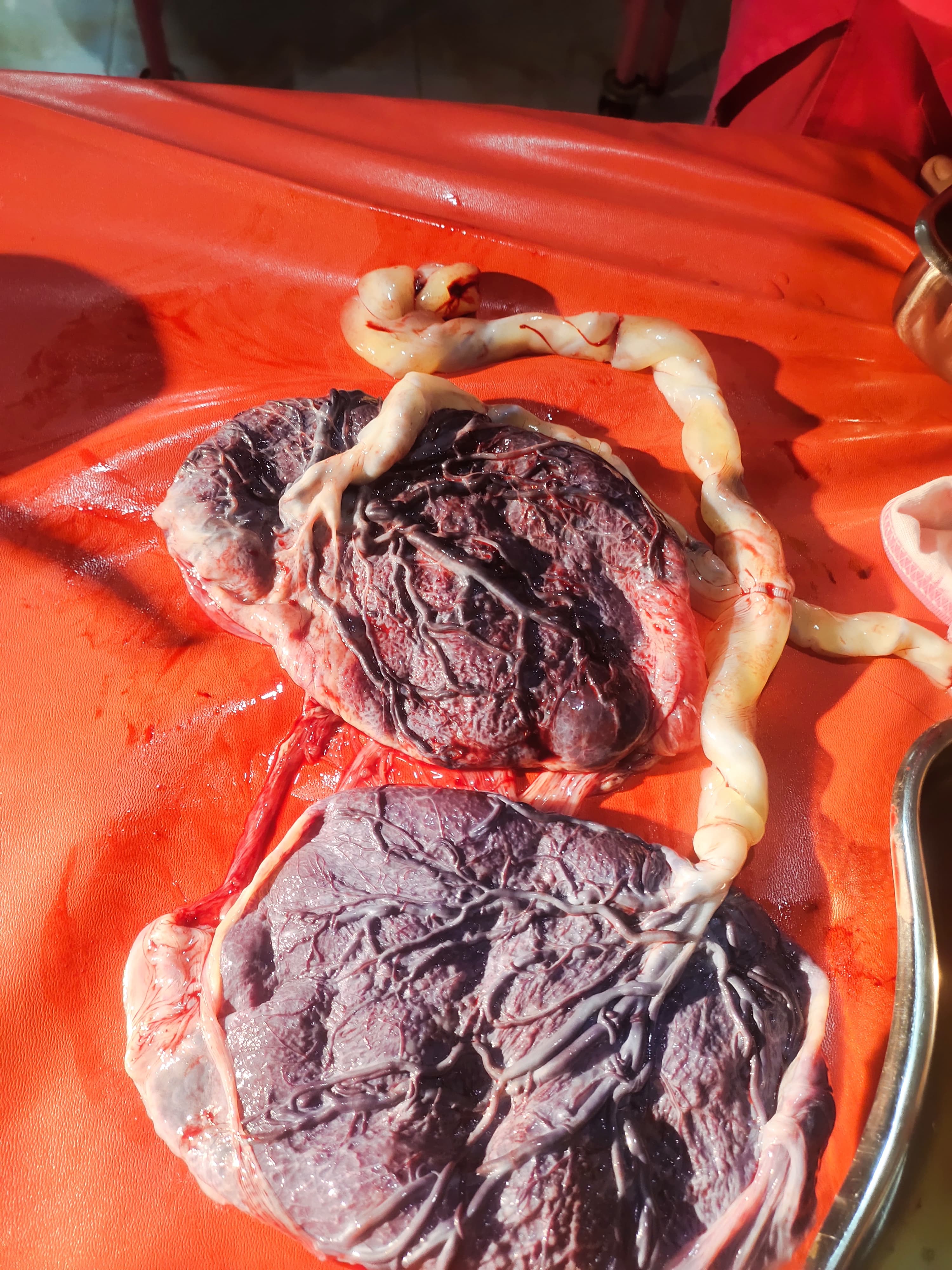 KLINIK TESYA MEDIKA MENOLONG PERSALINAN BAYI KEMBAR LAKI-LAKI dan PEREMPUAN YANG MEMILIKI PLASENTA MASING MASING